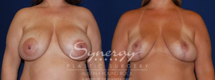 Before & After Revision Breast Augmentation Case 62 View #3 View in Austin, TX
