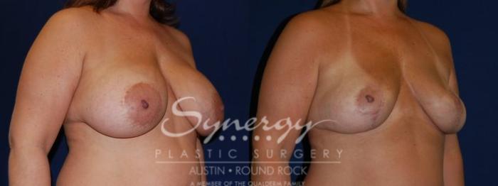 Before & After Revision Breast Augmentation Case 62 View #4 View in Austin, TX