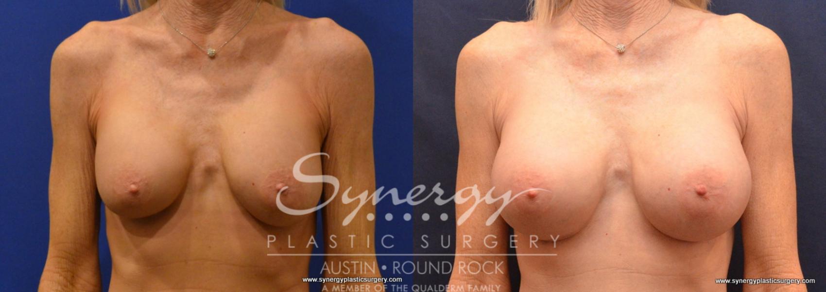 Before & After Revision Breast Augmentation Case 644 View #1 View in Austin, TX