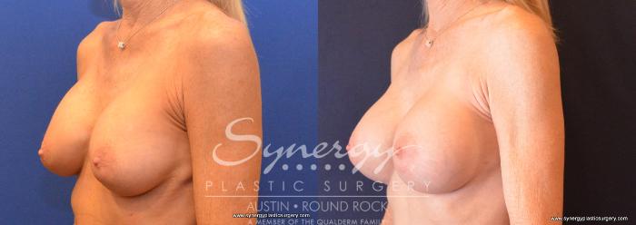 Before & After Revision Breast Augmentation Case 644 View #2 View in Austin, TX