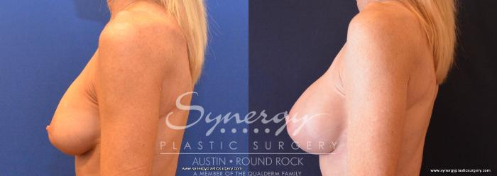 Before & After Revision Breast Augmentation Case 644 View #3 View in Austin, TX