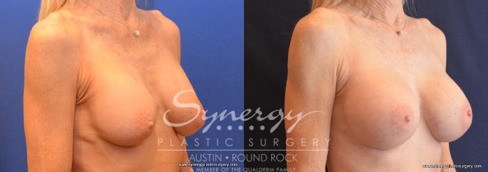 Before & After Revision Breast Augmentation Case 644 View #4 View in Austin, TX