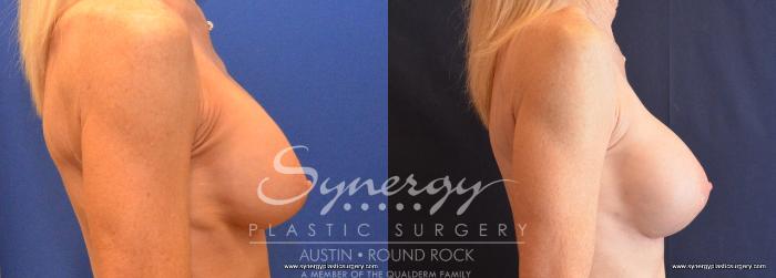 Before & After Revision Breast Augmentation Case 644 View #5 View in Austin, TX