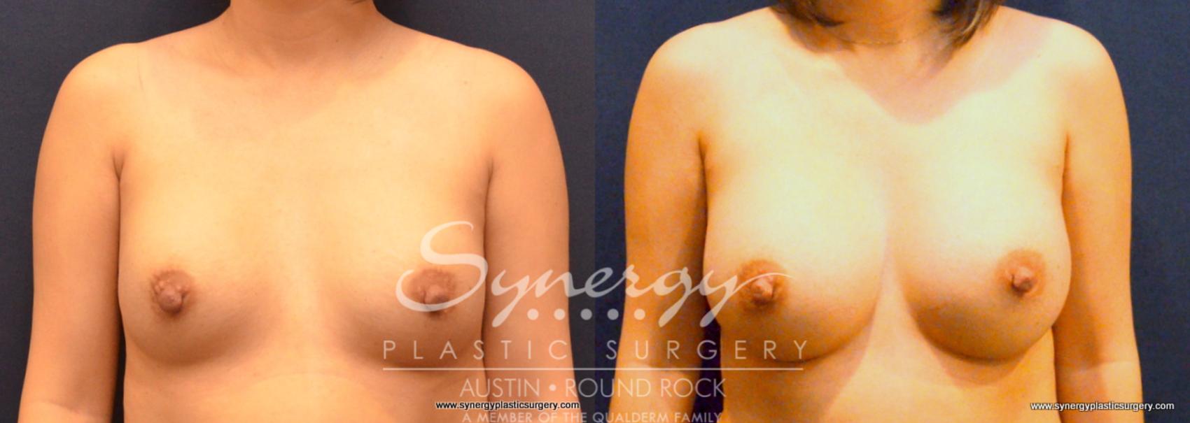 Before & After Revision Breast Augmentation Case 673 View #1 View in Austin, TX