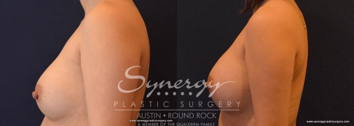 Before & After Revision Breast Augmentation Case 673 View #2 View in Austin, TX