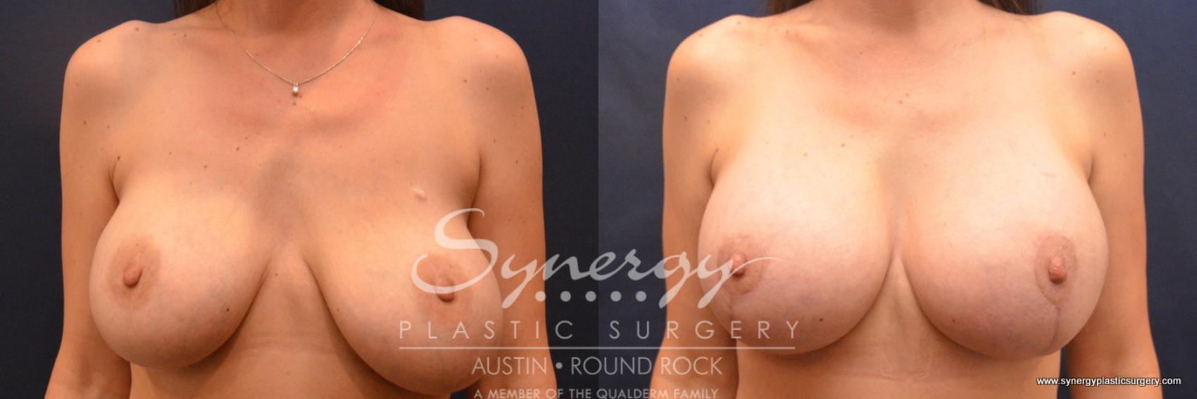 Before & After Revision Breast Augmentation Case 679 View #1 View in Austin, TX