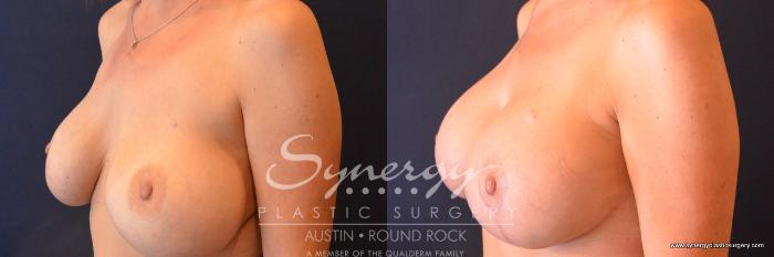 Before & After Revision Breast Augmentation Case 679 View #2 View in Austin, TX