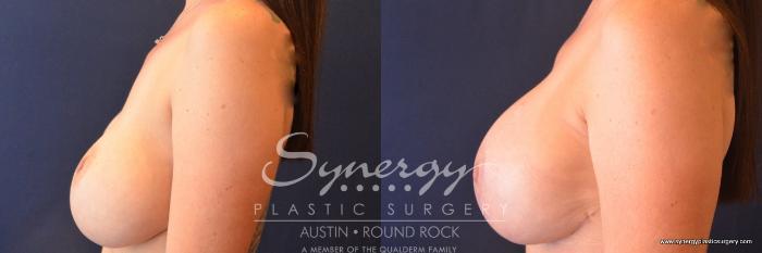 Before & After Revision Breast Augmentation Case 679 View #3 View in Austin, TX