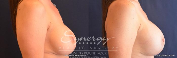 Before & After Revision Breast Augmentation Case 679 View #4 View in Austin, TX