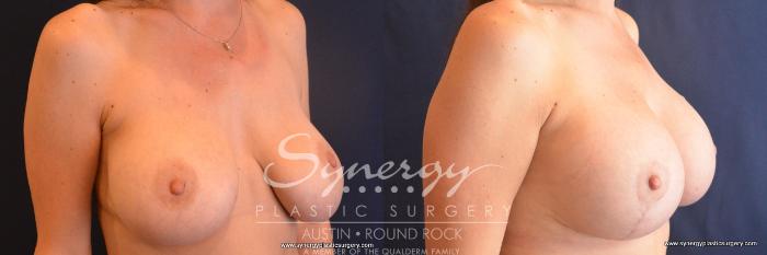 Before & After Revision Breast Augmentation Case 679 View #5 View in Austin, TX