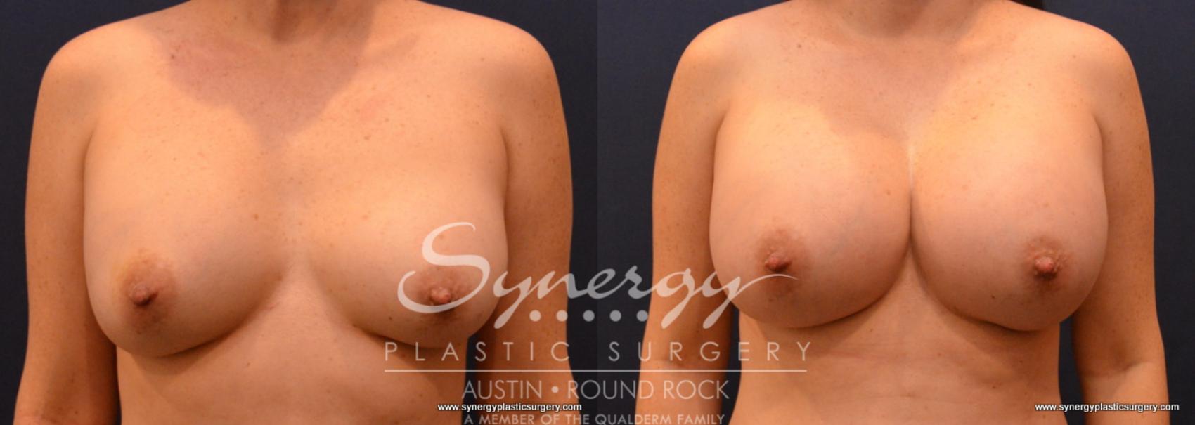 Before & After Revision Breast Augmentation Case 693 View #1 View in Austin, TX