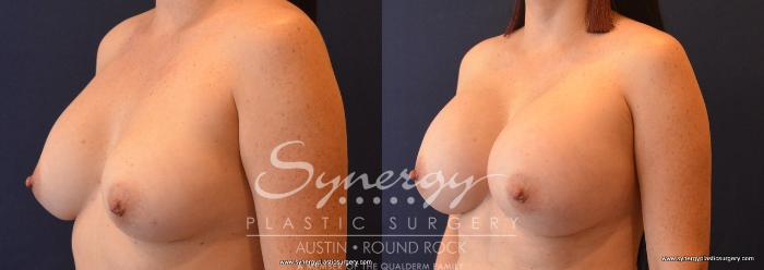 Before & After Revision Breast Augmentation Case 693 View #2 View in Austin, TX
