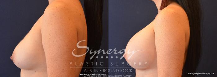 Before & After Revision Breast Augmentation Case 693 View #3 View in Austin, TX