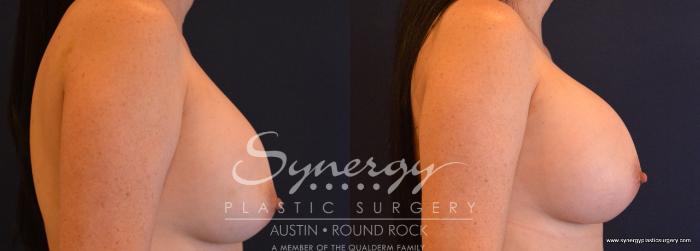 Before & After Revision Breast Augmentation Case 693 View #4 View in Austin, TX