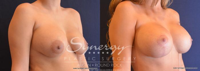 Before & After Revision Breast Augmentation Case 697 View #2 View in Austin, TX