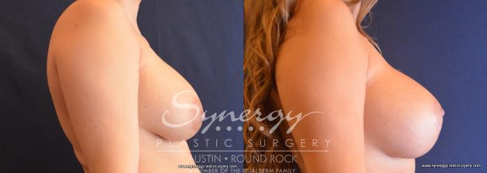 Before & After Revision Breast Augmentation Case 697 View #3 View in Austin, TX