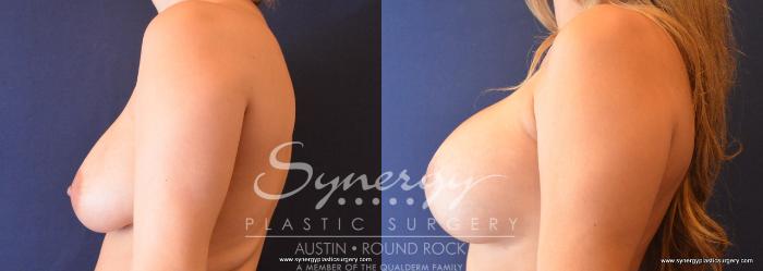 Before & After Revision Breast Augmentation Case 697 View #4 View in Austin, TX