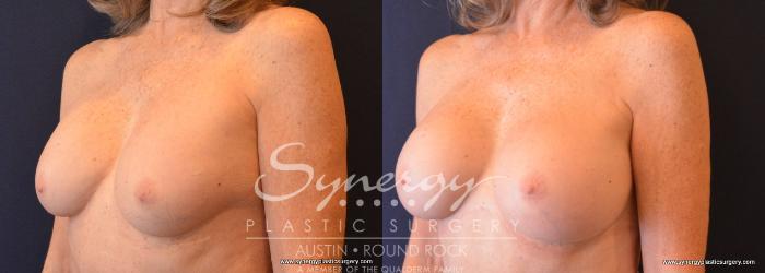Before & After Revision Breast Augmentation Case 709 View #2 View in Austin, TX