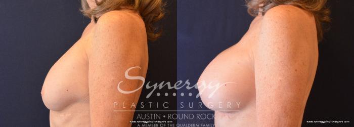 Before & After Revision Breast Augmentation Case 709 View #3 View in Austin, TX