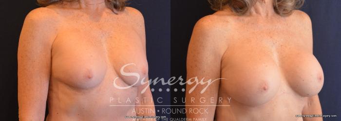 Before & After Revision Breast Augmentation Case 709 View #4 View in Austin, TX