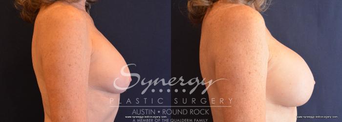 Before & After Revision Breast Augmentation Case 709 View #5 View in Austin, TX