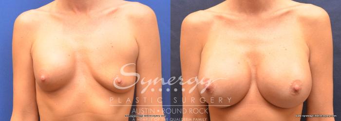 Before & After Revision Breast Augmentation Case 758 View #1 View in Austin, TX