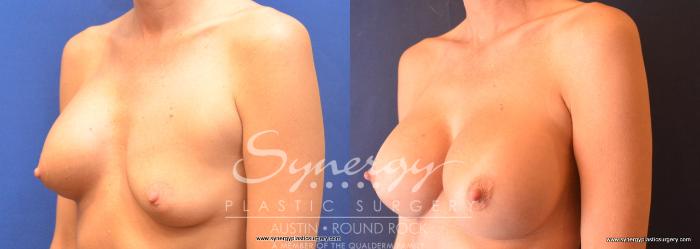 Before & After Revision Breast Augmentation Case 758 View #2 View in Austin, TX