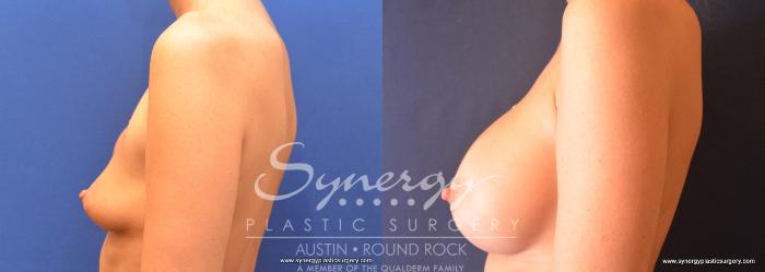 Before & After Revision Breast Augmentation Case 758 View #3 View in Austin, TX