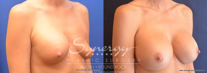Before & After Revision Breast Augmentation Case 758 View #4 View in Austin, TX
