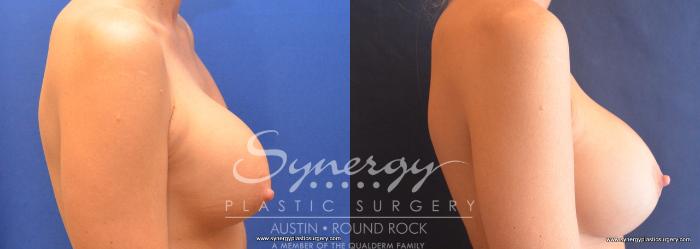 Before & After Revision Breast Augmentation Case 758 View #5 View in Austin, TX