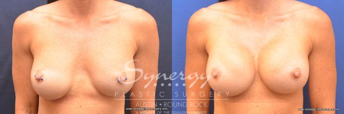 Before & After Revision Breast Augmentation Case 761 View #1 View in Austin, TX