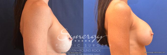 Before & After Revision Breast Augmentation Case 761 View #2 View in Austin, TX