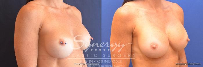 Before & After Revision Breast Augmentation Case 761 View #3 View in Austin, TX