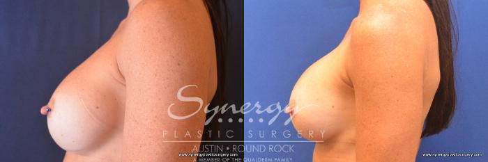 Before & After Revision Breast Augmentation Case 761 View #5 View in Austin, TX