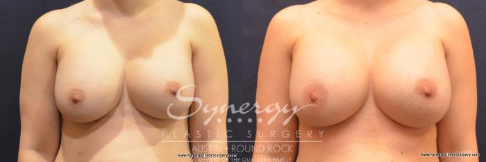 Before & After Revision Breast Augmentation Case 788 View #1 View in Austin, TX