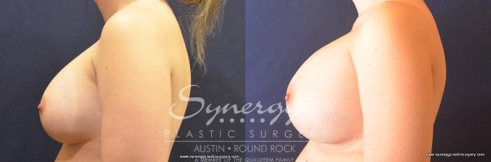 Before & After Revision Breast Augmentation Case 788 View #2 View in Austin, TX