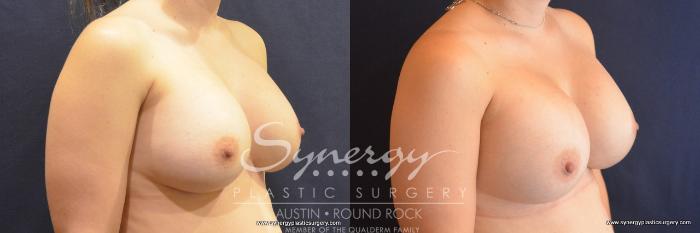 Before & After Revision Breast Augmentation Case 788 View #4 View in Austin, TX