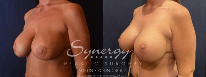 Implant exchange, Synergy plastic surgery
