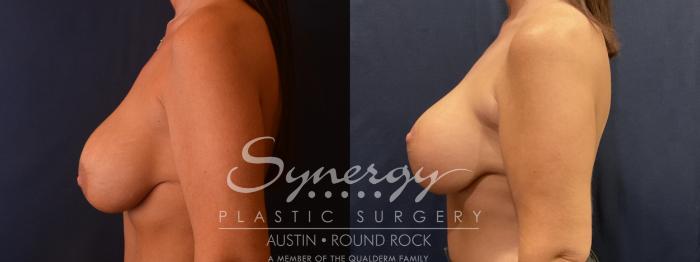 Implant exchange, Synergy plastic surgery