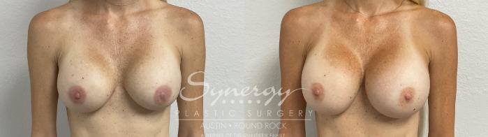 Before & After Revision Breast Augmentation Case 860 Front View in Austin, TX