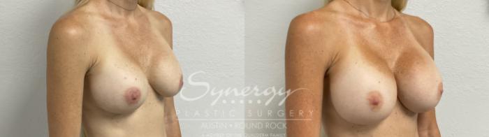 Before & After Revision Breast Augmentation Case 860 Left Oblique View in Austin, TX