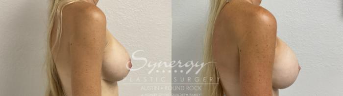 Before & After Revision Breast Augmentation Case 860 Left Side View in Austin, TX