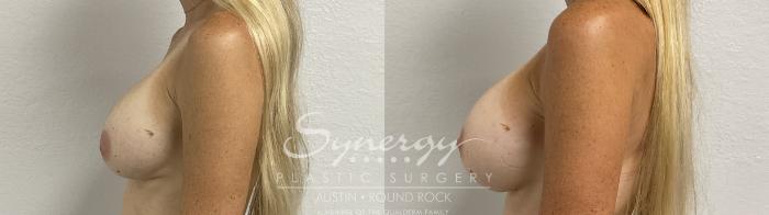 Before & After Revision Breast Augmentation Case 860 Right Side View in Austin, TX