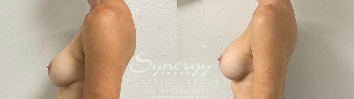 Before & After Revision Breast Augmentation Case 885 Right Side View in Austin, TX