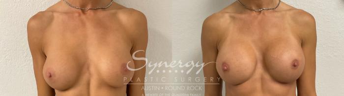 Before & After Revision Breast Augmentation Case 890 Front View in Austin, TX