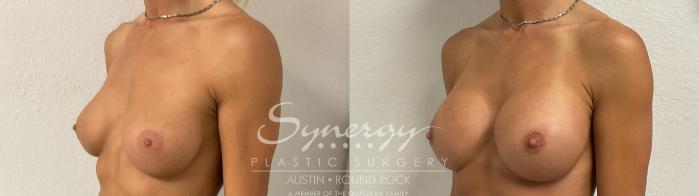 Before & After Revision Breast Augmentation Case 890 Right Oblique View in Austin, TX