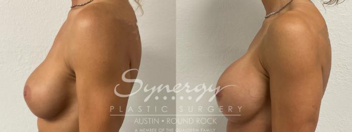 Before & After Revision Breast Augmentation Case 890 Right Side View in Austin, TX