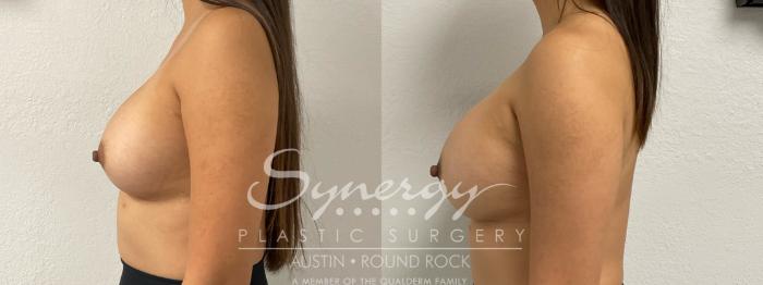 Before & After Revision Breast Augmentation Case 891 Left Side View in Austin, TX