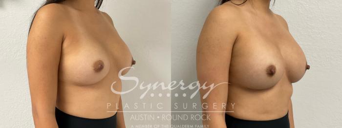 Before & After Revision Breast Augmentation Case 891 Right Oblique View in Austin, TX