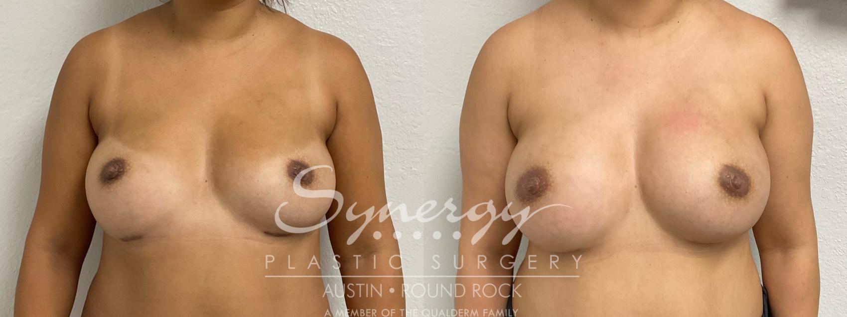 Before & After Revision Breast Augmentation Case 892 Front View in Austin, TX